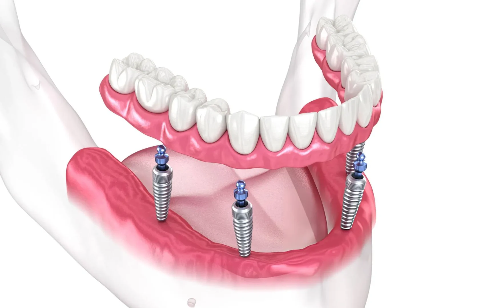 All on 6 Dental Implant Service