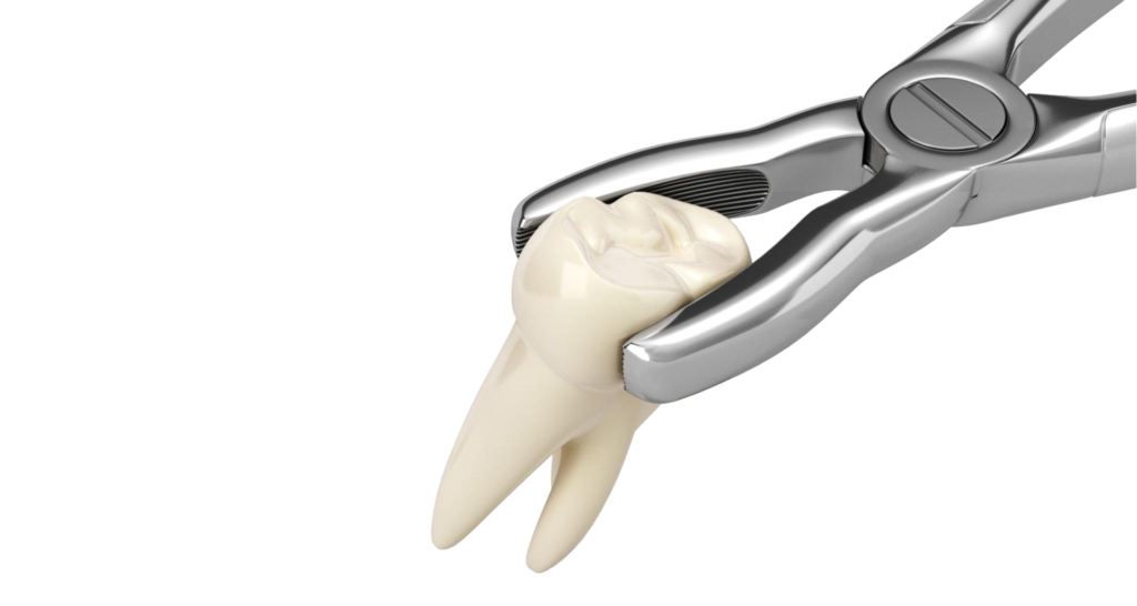Dental Extraction 