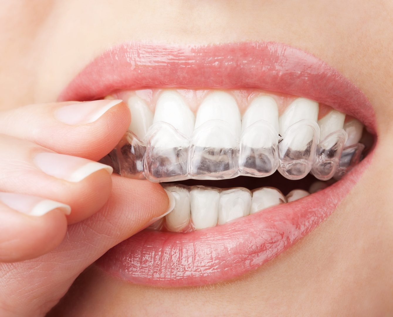 Cosmetic Dentistry Lancaster OH