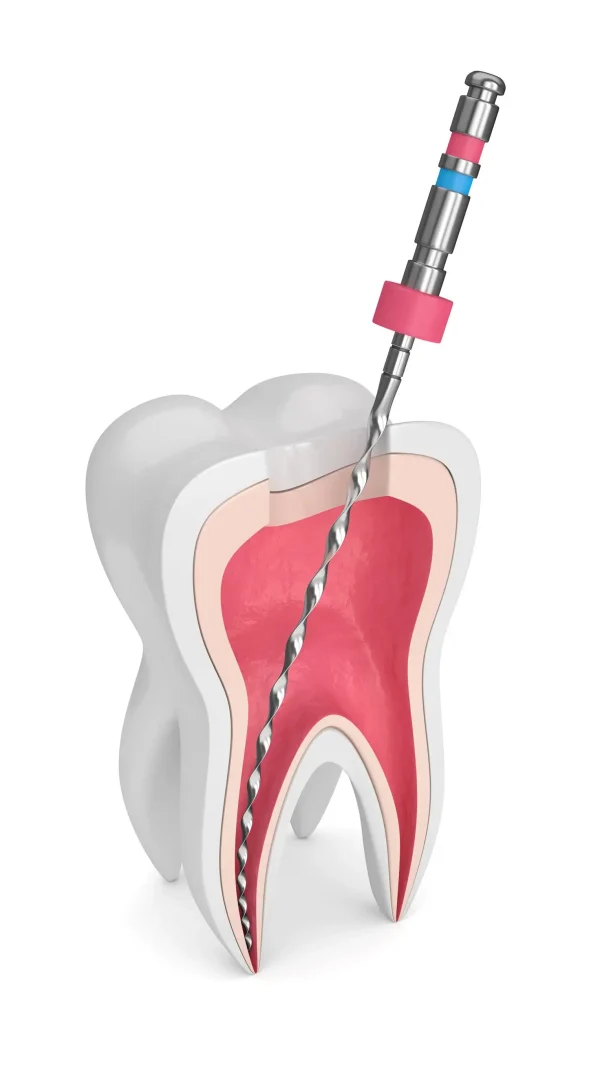 Root Canals Therapy