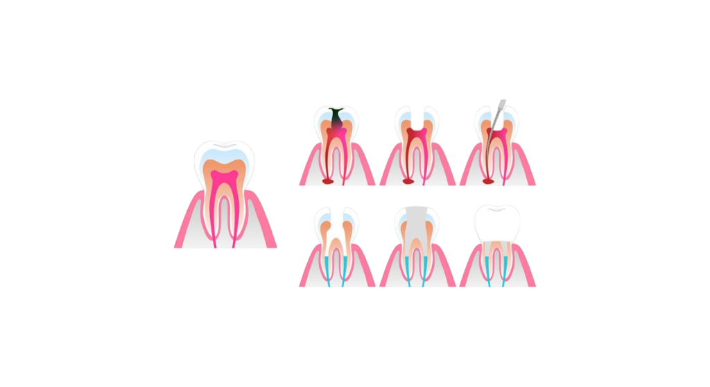 Root Canals Treatment