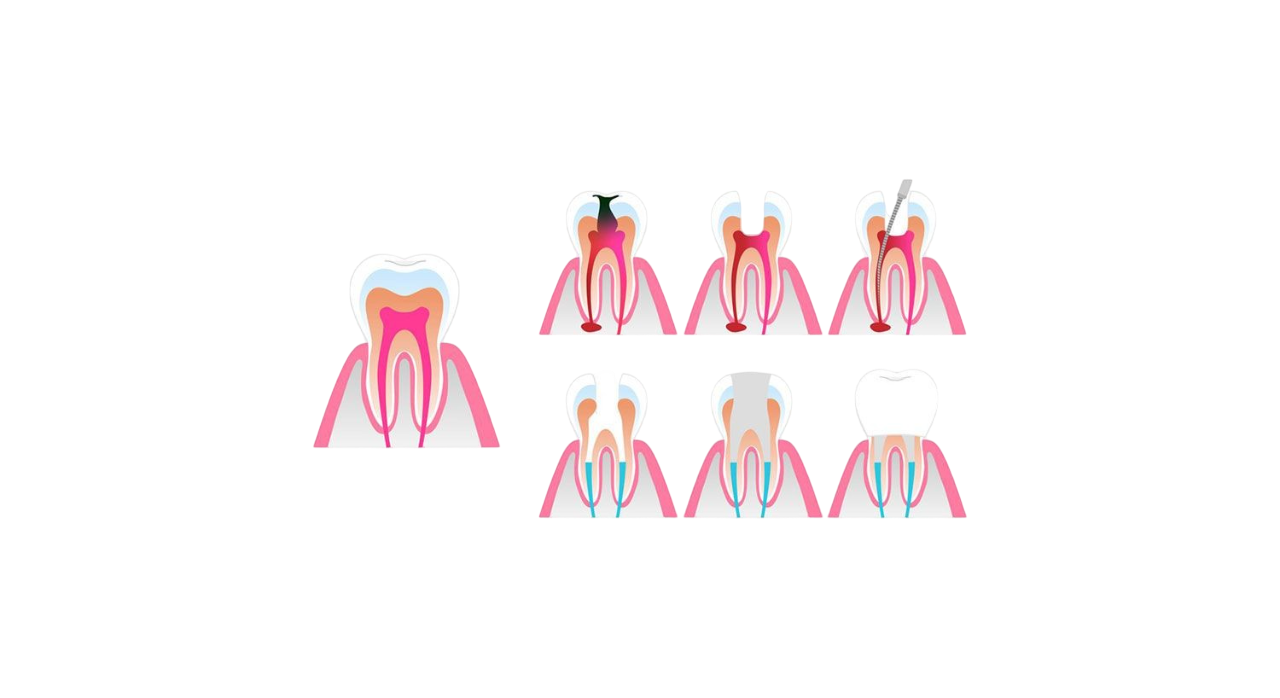 Root Canals Treatment