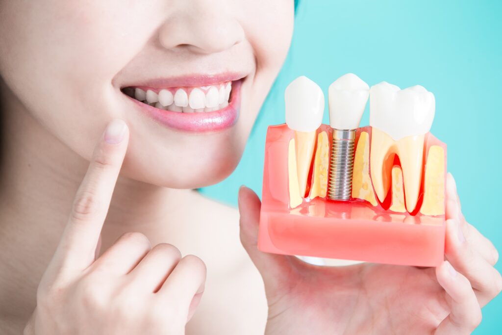 Dental Implants Lancaster OH