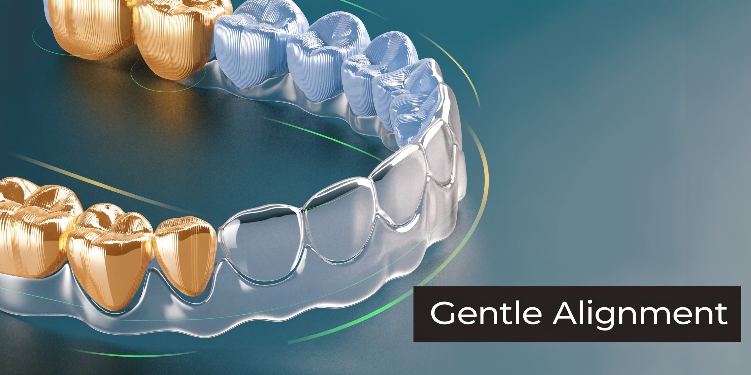A 3D dental model showcasing clear aligners moving gold and blue metallic teeth into proper alignment.