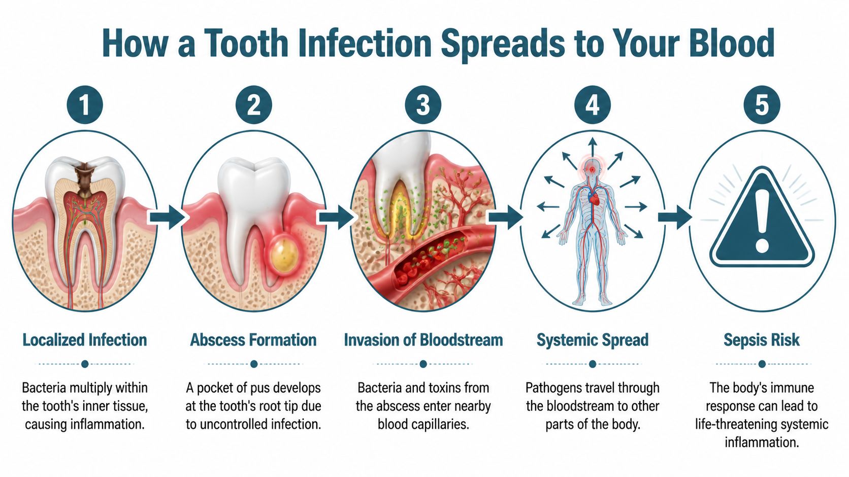 A five-step medical diagram illustrating how an untreated tooth infection can spread into the bloodstream causing sepsis.