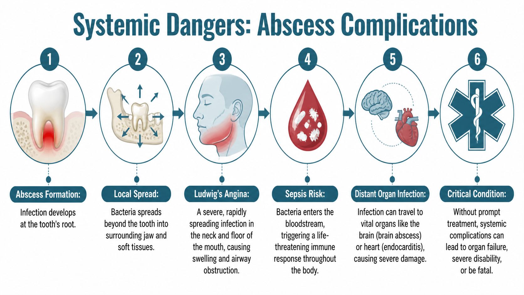 A diagram illustrating the progressive systemic health risks and complications starting from a tooth abscess.