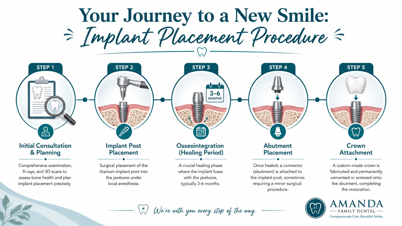 An infographic detailing the five steps of a dental implant placement procedure from consultation to crown attachment.