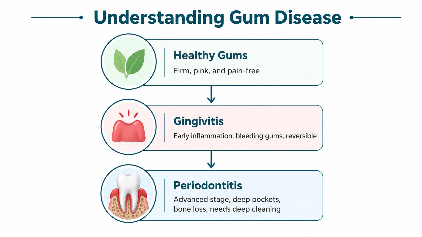 A diagram illustrating the progression of gum disease from healthy gums to gingivitis and advanced periodontitis.