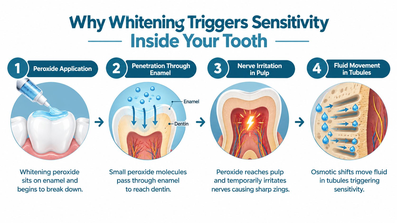 A four-step infographic illustrating how whitening peroxide penetrates teeth to cause temporary nerve sensitivity and pain.