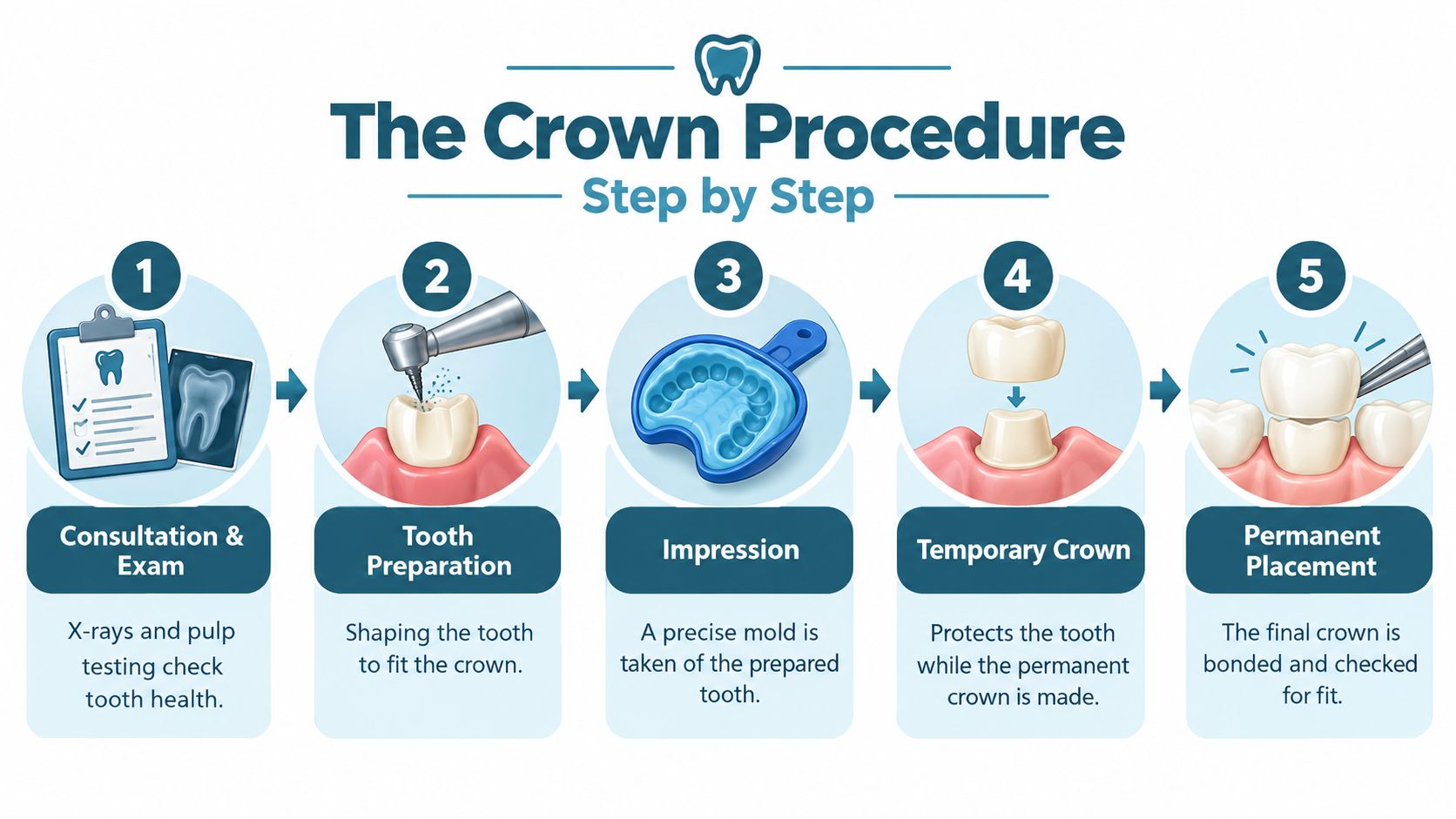 A five-step infographic illustrating the dental crown procedure, from consultation to final permanent crown placement.