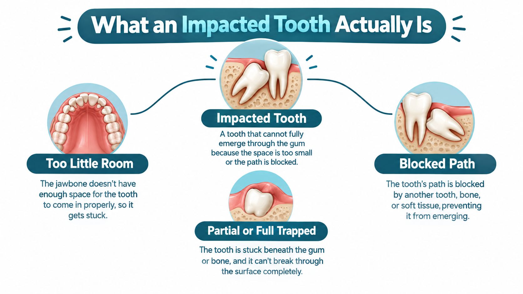 An infographic showing the causes of an impacted tooth including lack of space and blocked paths.