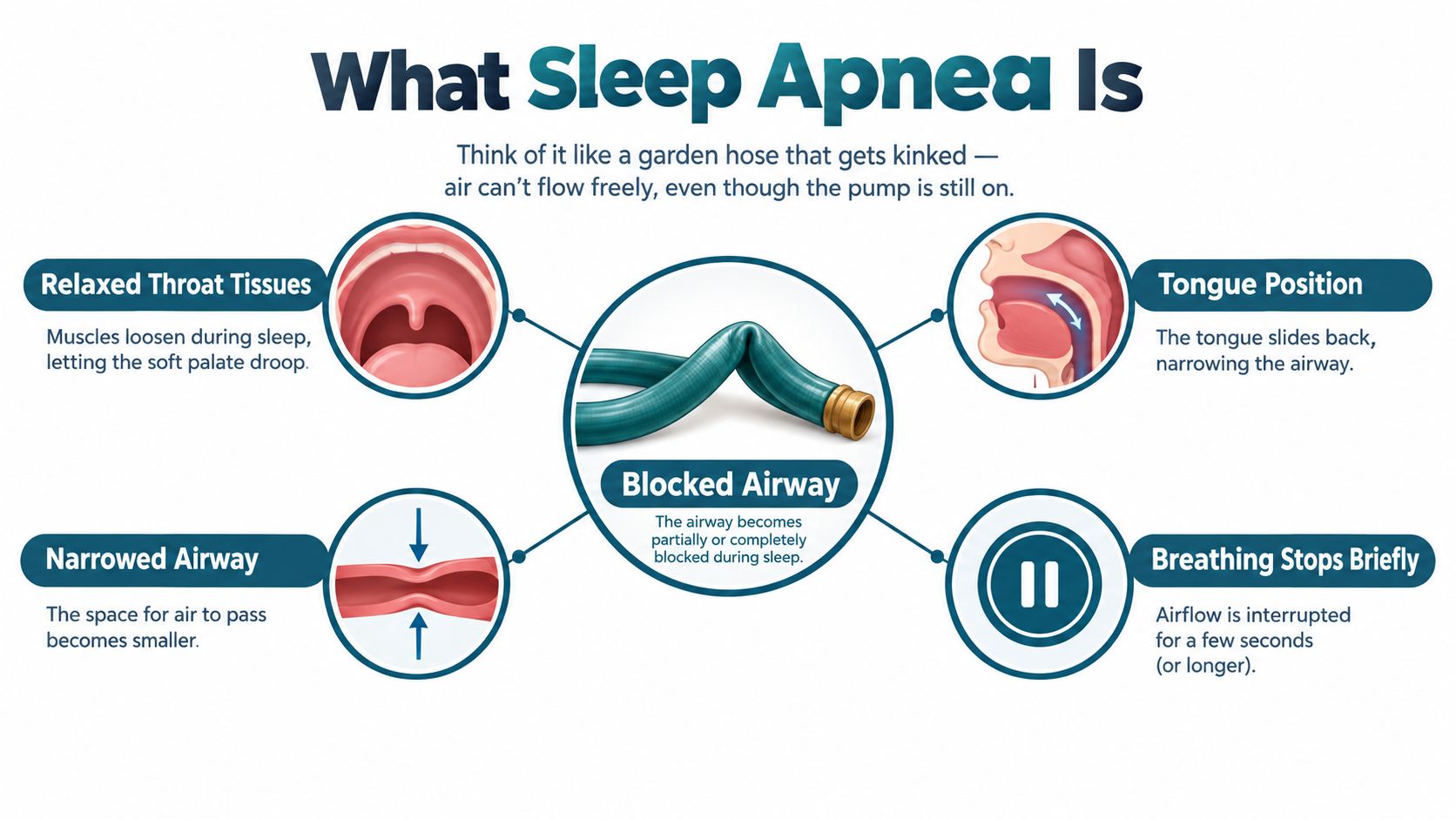 A diagram explaining how sleep apnea blocks the airway, showing the throat and tongue positions.